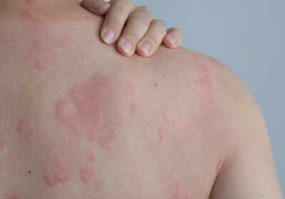 Skin Rash